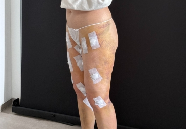 Recovery after liposuction of lipedema: the testimony of Sylvie
