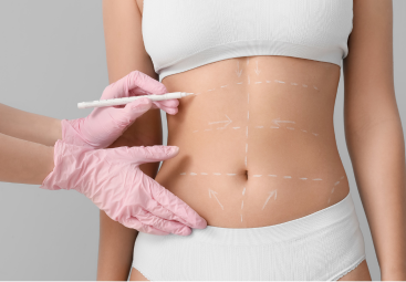 Can Medical weight-loss Replace Liposuction? A Comprehensive Guide to Body Contouring in the UK